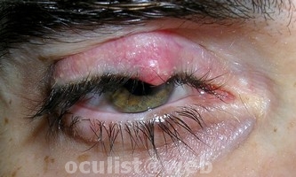 papilloma virus occhi)